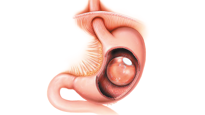 Intragastrisches Ballonverfahren 