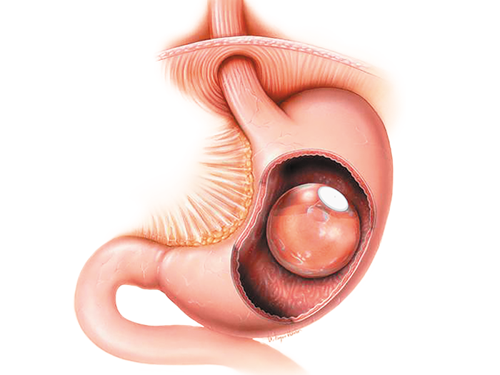 Intragastrisches Ballonverfahren